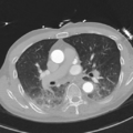 Aortic dissection - DeBakey type II (Radiopaedia 64302-73082 Axial lung window 29).png