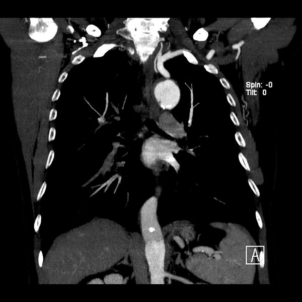 File:Aortic dissection - De Bakey type III - Stanford B (Radiopaedia 21903-21882 C 13).jpg