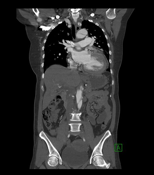 File:Aortic dissection with renal ischemia (Radiopaedia 76573-88338 C 12).jpg