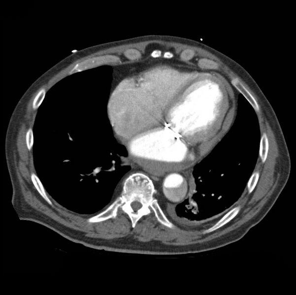 File:Aortic dissection with rupture into pericardium (Radiopaedia 12384-12647 A 40).jpg