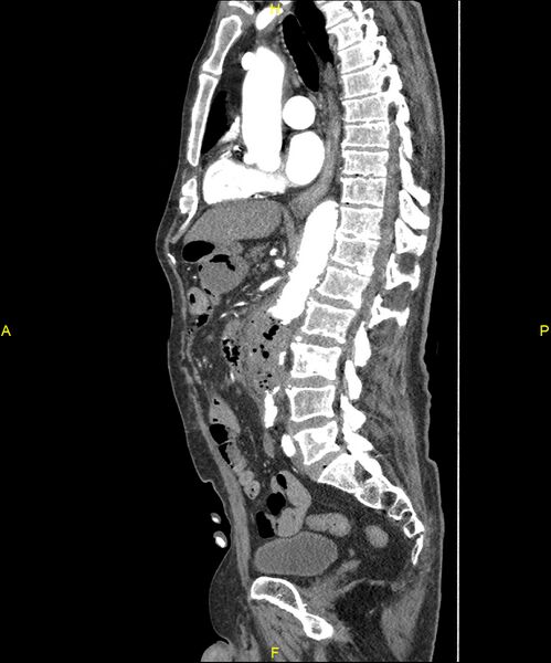 File:Aortoenteric fistula (Radiopaedia 84308-99603 C 181).jpg
