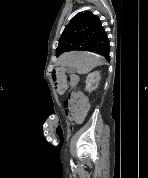 File:Aortoenteric fistula (Radiopaedia 84308-99603 C 82).jpg