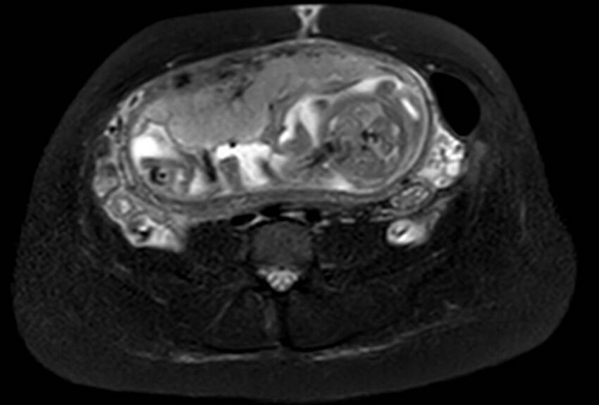 Appendicitis in gravida (MRI) (Radiopaedia 89433-106395 Axial T2 SPAIR 46).jpg