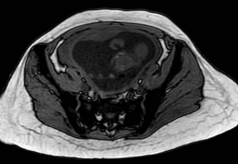 File:Appendicitis in gravida (MRI) (Radiopaedia 89433-106395 D 53).jpg