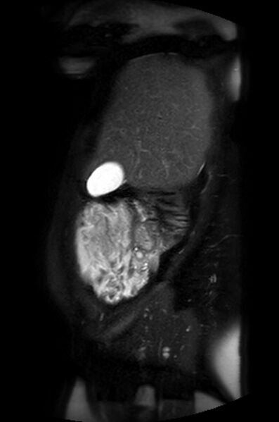 File:Appendicitis in gravida (MRI) (Radiopaedia 89433-106395 Sagittal T2 SPAIR 52).jpg