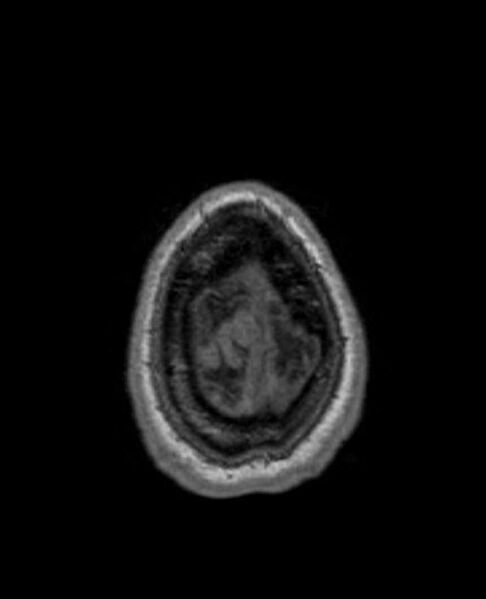 File:Arachnoid cyst- extremely large (Radiopaedia 68741-78451 Axial T1 74).jpg