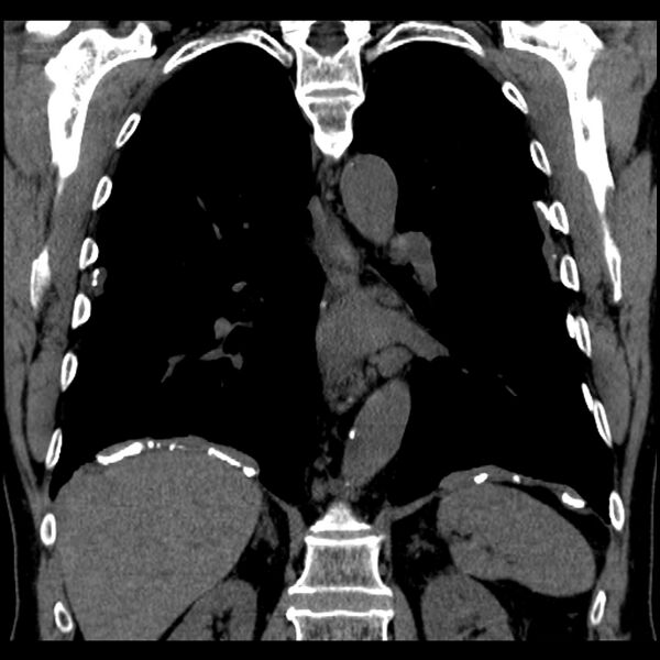 File:Asbestos-related pleural plaques (Radiopaedia 39069-41255 Coronal non-contrast 32).jpg