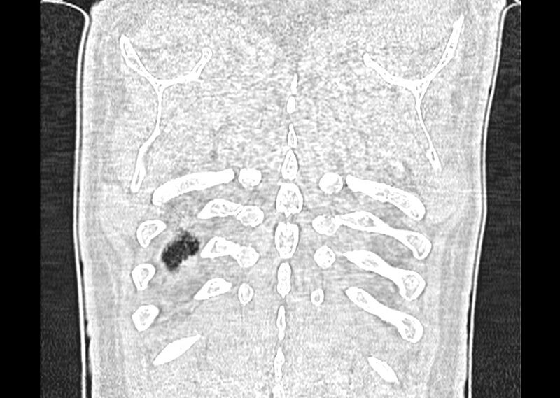 File:Asbestos pleural placques (Radiopaedia 57905-64872 Coronal lung window 279).jpg