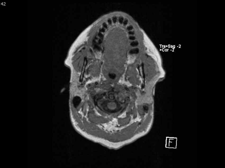 Atypical meningioma - intraosseous (Radiopaedia 64915-74572 Axial T1 42).jpg