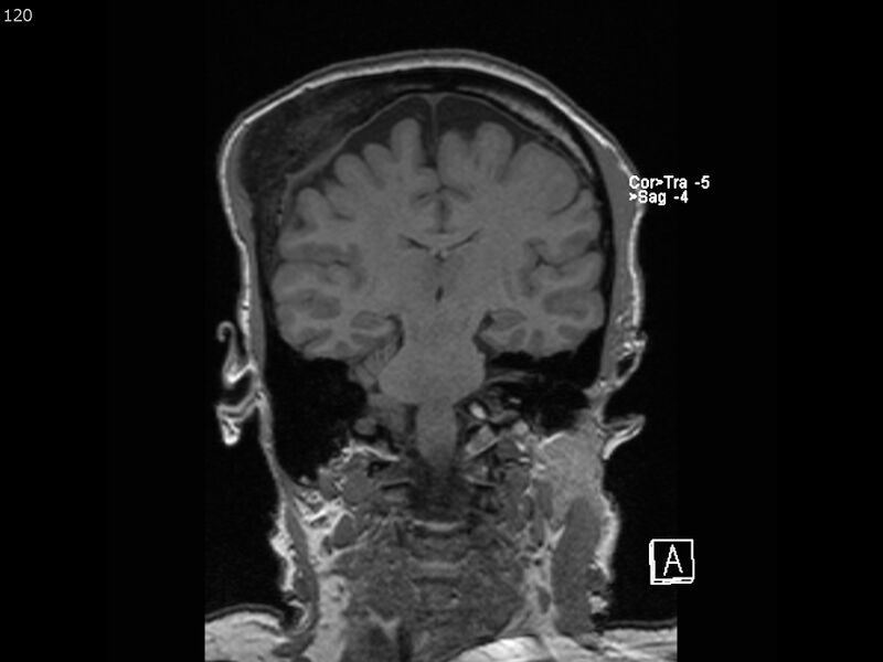 File:Atypical meningioma - intraosseous (Radiopaedia 64915-74572 Coronal T1 120).jpg