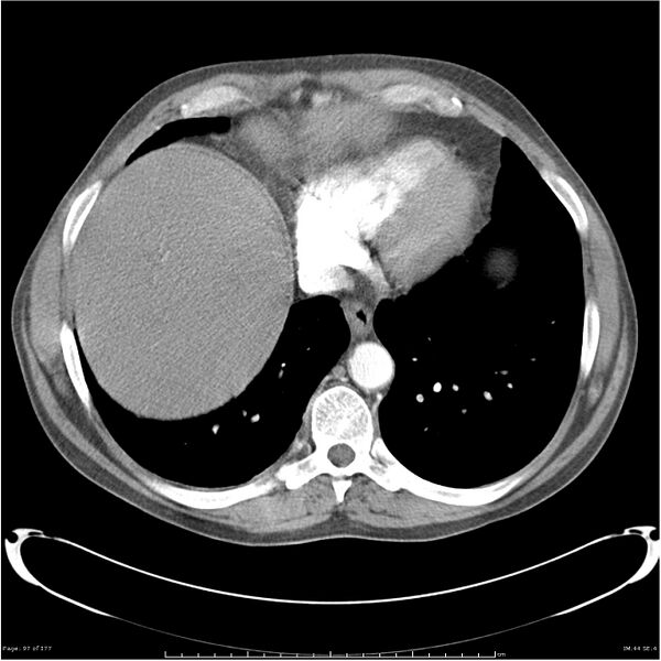 File:Atypical pneumonia - Q fever (Radiopaedia 21993-21989 C+ arterial phase 39).jpg