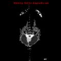 Atypical teratoid rhabdoid tumor (Radiopaedia 10712-11183 Axial ADC 16).jpg