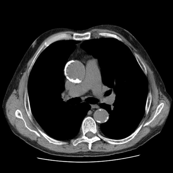 File:Autosomal dominant polycystic kidney disease (Radiopaedia 27851-28094 Axial non-contrast 24).jpg