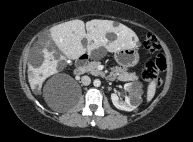 File:Autosomal dominant polycystic kidney disease (Radiopaedia 57124-64017 A 50).jpg