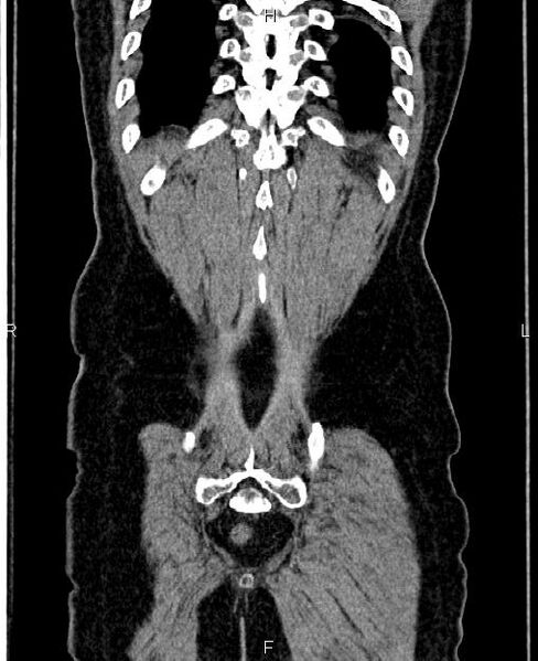 File:Autosomal dominant polycystic kidney disease (Radiopaedia 87830-104287 Coronal non-contrast 61).jpg
