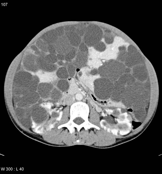 File:Autosomal dominant polycystic kidney disease with extensive hepatic involvement (Radiopaedia 5204-6971 B 14).jpg