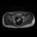 Avascular necrosis of the hip (Radiopaedia 29563-30067 Axial T2 1).jpg