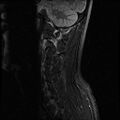 Axis fracture - MRI (Radiopaedia 71925-82375 Sagittal STIR 9).jpg