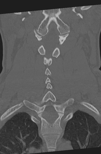 File:Axis peg fracture (type 3) and atlas lateral mass (type 4) fracture (Radiopaedia 37474-39324 Coronal bone window 30).png