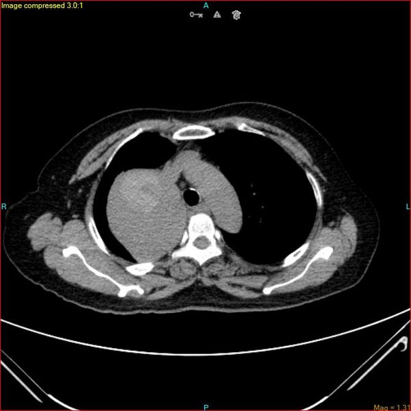 File:Azygos vein aneurysm (Radiopaedia 77824-90130 A 18).jpg