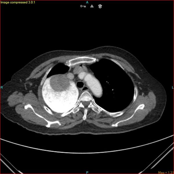 File:Azygos vein aneurysm (Radiopaedia 77824-90130 B 17).jpg