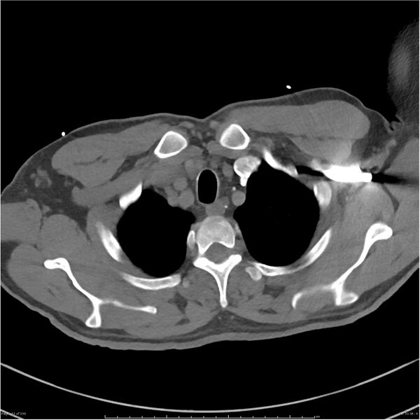 File:Azygos venous system anatomy (CT pulmonary angiography) (Radiopaedia 25928-26077 Axial C+ CTPA 11).jpg