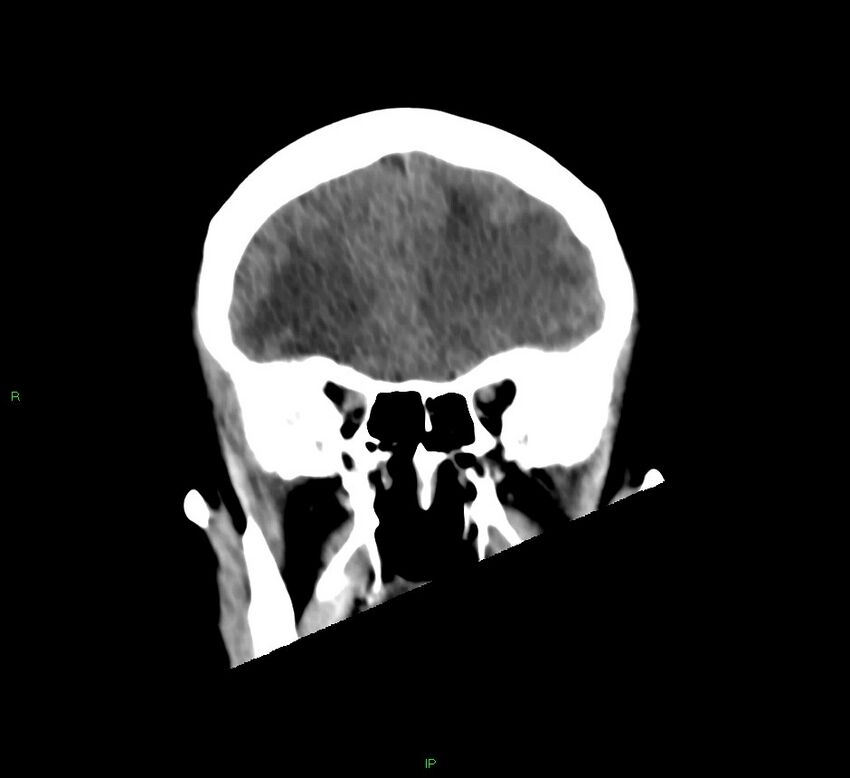 Basal ganglia hemorrhage (Radiopaedia 58766-65988 Coronal non-contrast 49).jpg