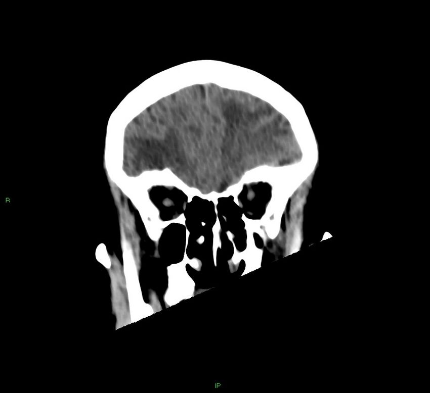 Basal ganglia hemorrhage (Radiopaedia 58766-65988 Coronal non-contrast 51).jpg