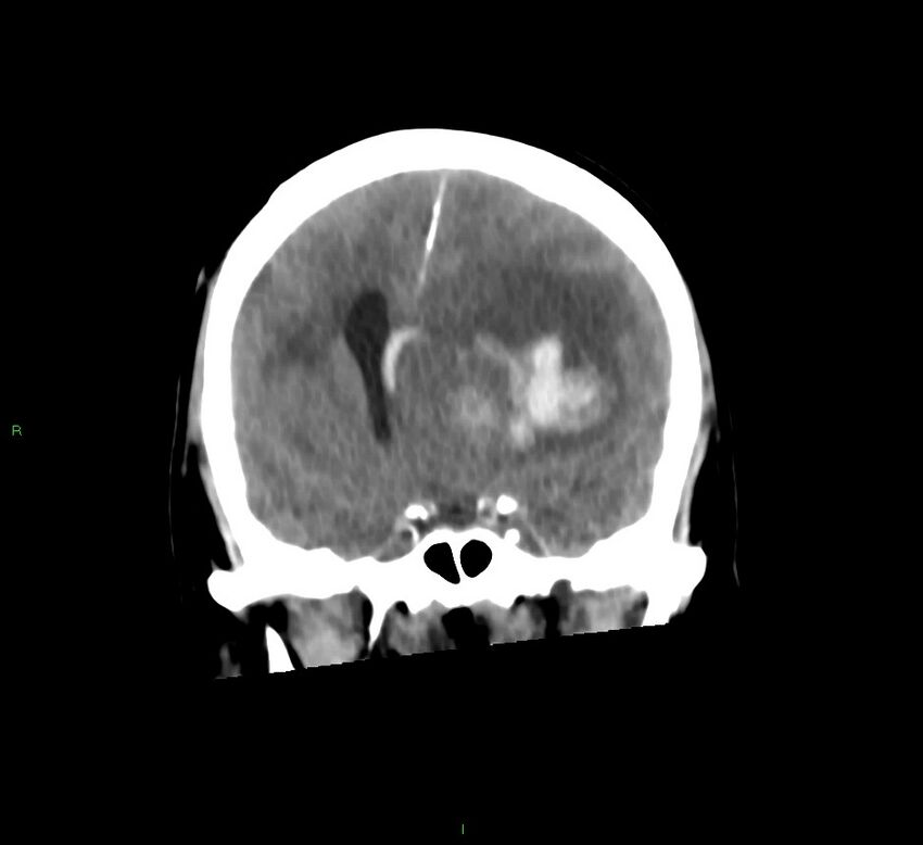 Basal ganglia hemorrhage (Radiopaedia 58775-66008 Coronal non-contrast 41).jpg