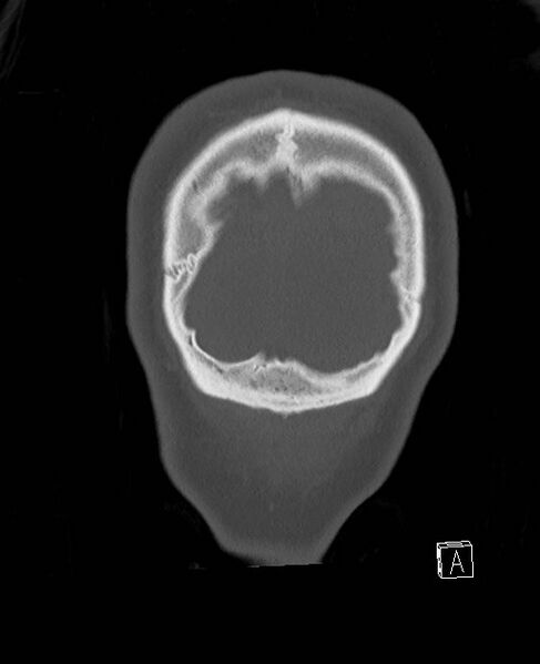 File:Base of skull fracture with bilateral Le Fort fractures (Radiopaedia 47094-51638 Coronal bone window 6).jpg