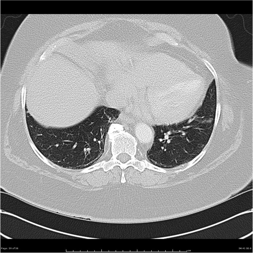 Benign metastasizing leiomyoma (Radiopaedia 26803-26962 Axial lung window 39).jpg
