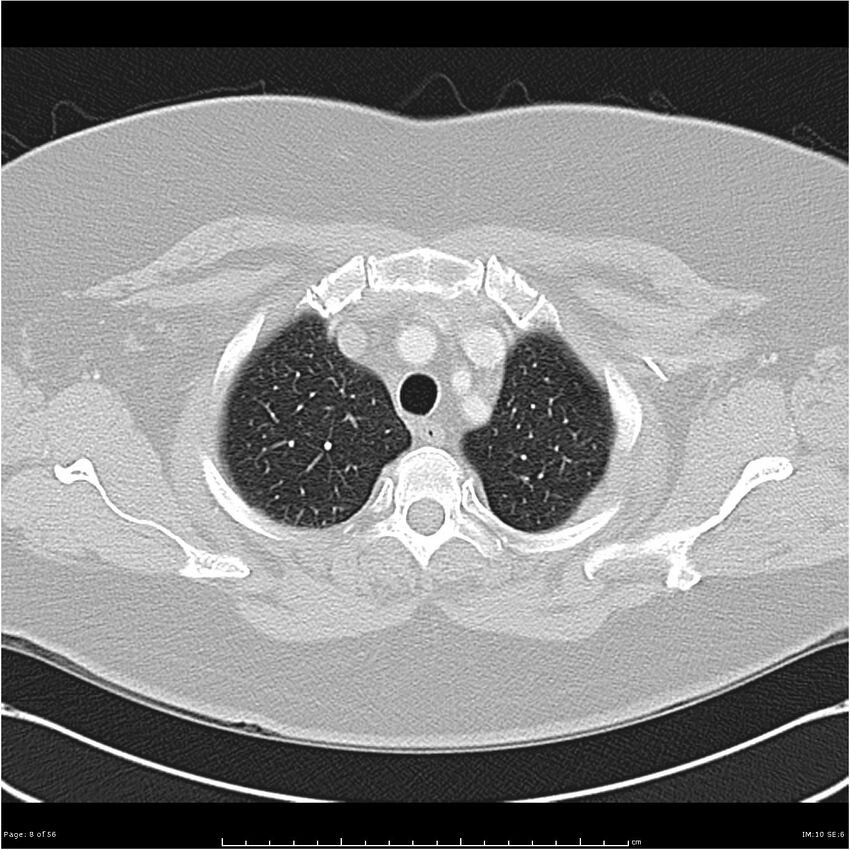 Benign metastasizing leiomyoma (Radiopaedia 26803-26962 Axial lung window 8).jpg