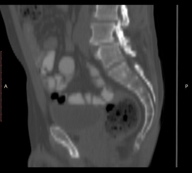 File:Bertolotti syndrome (Radiopaedia 58974-66235 Sagittal bone window 21).jpg