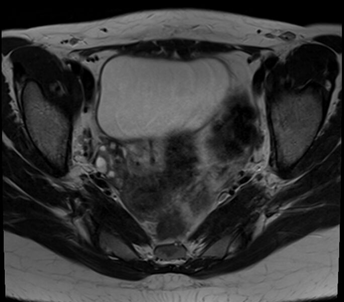 File:Bicornuate uterus (Radiopaedia 71214-81511 Axial T2 18).jpg
