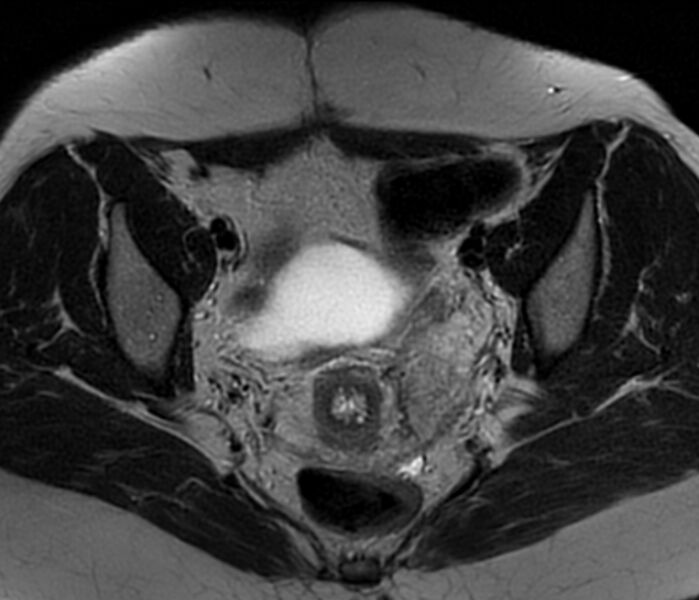 File:Bicornuate uterus (Radiopaedia 76407-88114 Axial T2 14).jpg