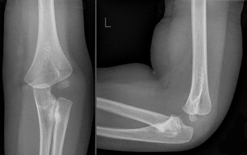 File:Bilateral congenital radial head dislocation in radioulnar synostosis (Radiopaedia 38087-40078 Frontal and Lateral 1).jpg