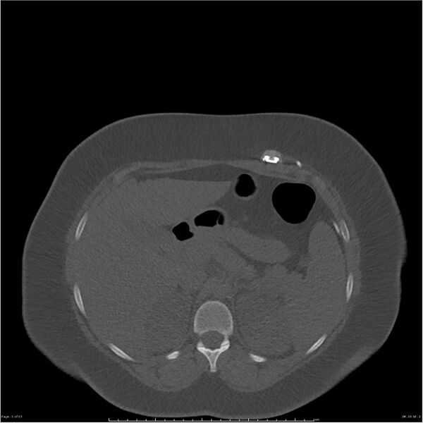 File:Bilateral lumbar ribs (Radiopaedia 25862-26010 bone window 5).jpg