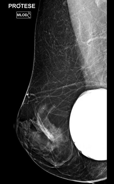 File:Bilateral mammoplasty (Radiopaedia 82984-97337 MLO 1).jpg