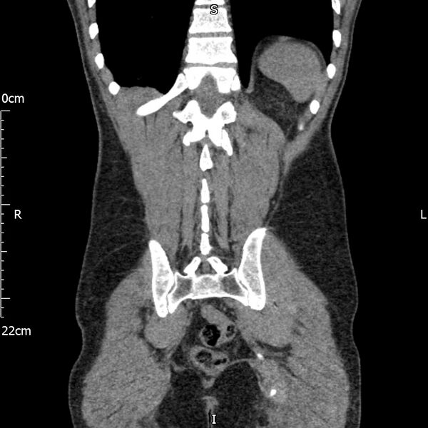 File:Bilateral medullary nephrocalcinosis with ureteric calculi (Radiopaedia 71269-81569 Coronal non-contrast 59).jpg