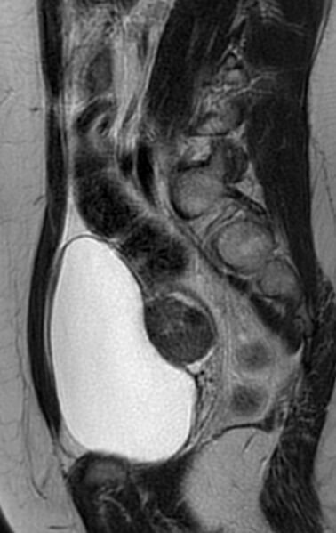 File:Bilateral ovarian fibrothecomas - adolescent (Radiopaedia 86604-102707 Sagittal T2 12).jpg