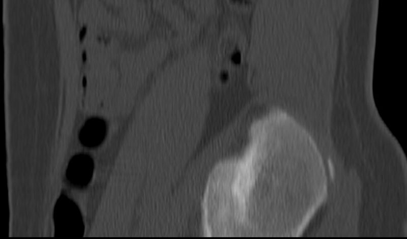 File:Bilateral pars defect (Radiopaedia 26691-26846 Sagittal bone window 59).jpg