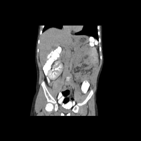 File:Bilateral renal malrotation (Radiopaedia 30901-31606 Coronal C+ delayed 5).jpg