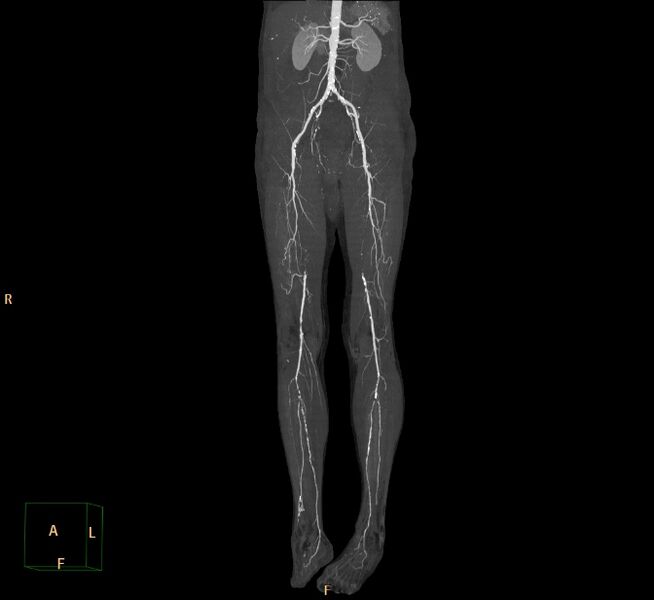 File:Bilateral superficial femoral arterial occlusion (Radiopaedia 25682-25857 3D MIP 25).jpg