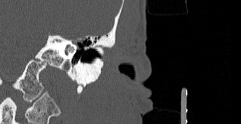 File:Bilateral temporal bone fractures (Radiopaedia 29482-29970 Coronal 257).jpg