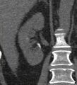 Bile leak from accessory duct(s) of Luschka post cholecystectomy (Radiopaedia 40736-43389 B 51).jpg