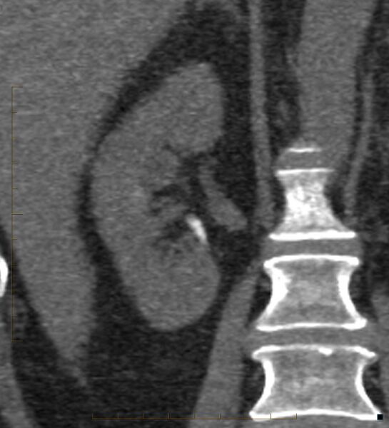 File:Bile leak from accessory duct(s) of Luschka post cholecystectomy (Radiopaedia 40736-43389 B 51).jpg