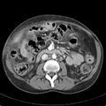Biliary necrosis - liver transplant (Radiopaedia 21876-21846 B 36).jpg