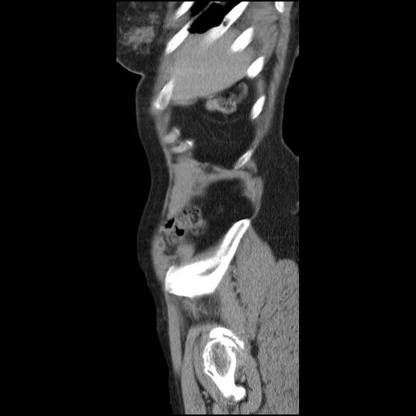 File:Bladder tumor detected on trauma CT (Radiopaedia 51809-57609 E 65).jpg
