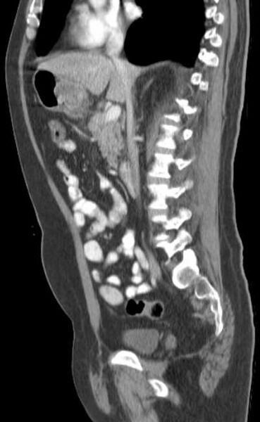 File:Bleeding duodenal ulcer and adenomyomatosis of gallbladder (Radiopaedia 61834-69861 C 44).jpg