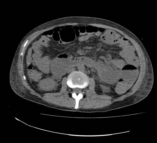 File:Bowel lymphoma complicated by bleeding after therapy (Radiopaedia 55601-62110 Axial non-contrast 39).jpg